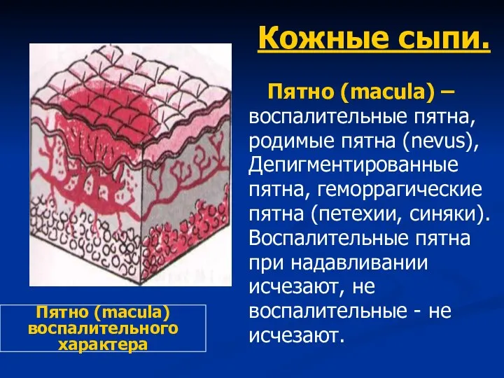 Кожные сыпи. Пятно (macula) – воспалительные пятна, родимые пятна (nevus),