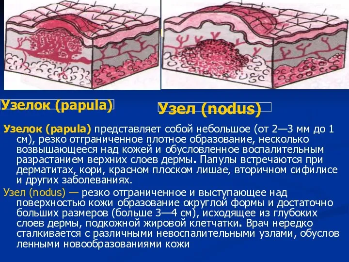 Узелок (papula) Узелок (papula) представляет собой небольшое (от 2—3 мм до 1 см),