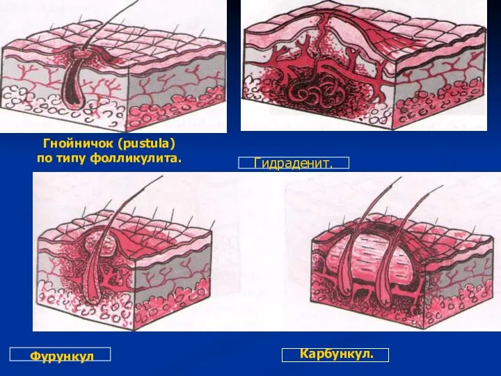 Гнойничок (pustula) по типу фолликулита.