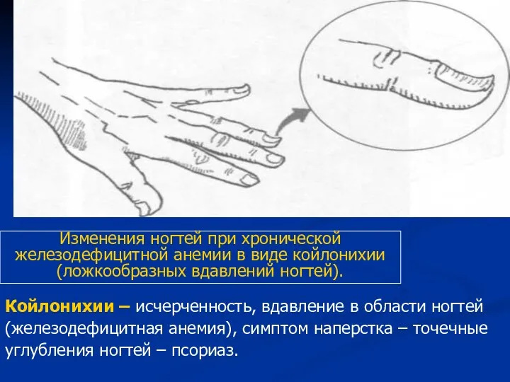 Койлонихии – исчерченность, вдавление в области ногтей (железодефицитная анемия), симптом наперстка – точечные