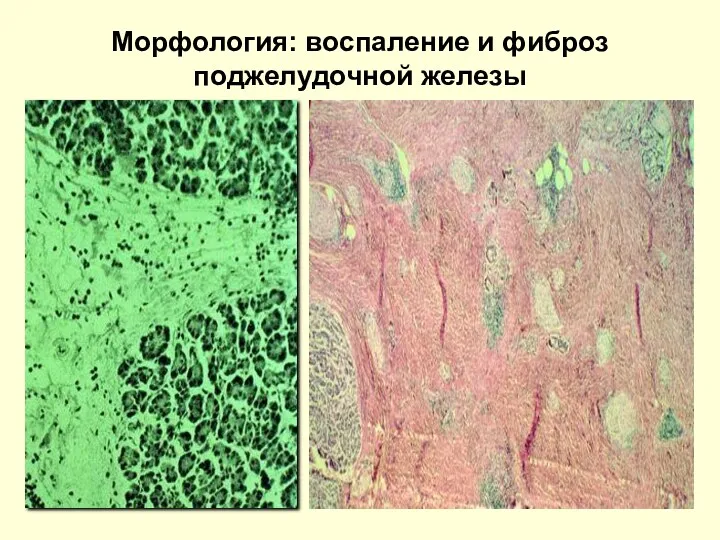 Морфология: воспаление и фиброз поджелудочной железы