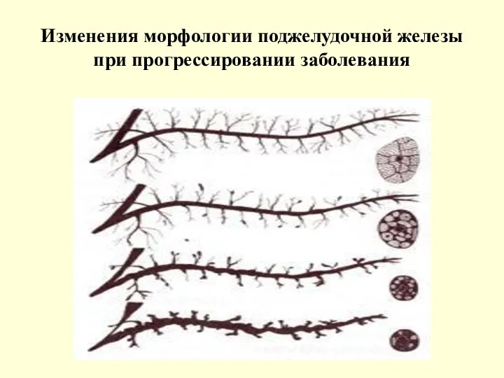 Изменения морфологии поджелудочной железы при прогрессировании заболевания