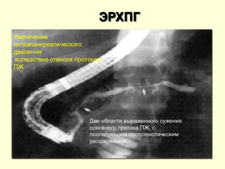 ЭРХПГ Две области выраженного сужения основного протока ПЖ, с последующим