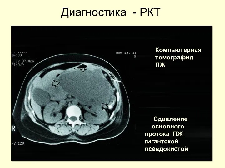 Сдавление основного протока ПЖ гигантской псевдокистой Компьютерная томография ПЖ Диагностика - РКТ