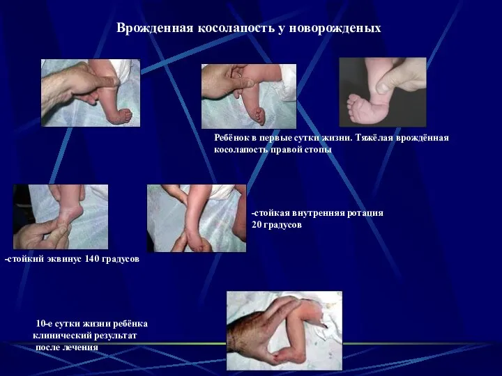 Врожденная косолапость у новорожденых Ребёнок в первые сутки жизни. Тяжёлая