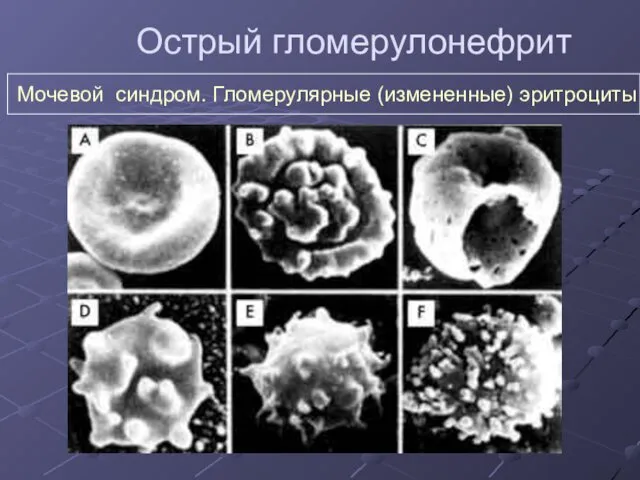 Острый гломерулонефрит Мочевой синдром. Гломерулярные (измененные) эритроциты