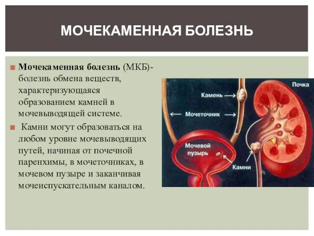 Мочекаменная болезнь (МКБ)- болезнь обмена веществ, характеризующаяся образованием камней в