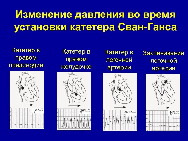 Изменение давления во время установки катетера Сван-Ганса Катетер в правом