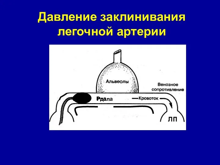 Рла Рдзла Давление заклинивания легочной артерии