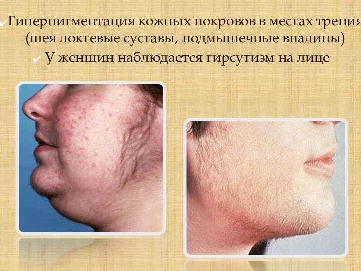 Гиперпигментация кожных покровов в местах трения (шея локтевые суставы, подмышечные впадины) У женщин