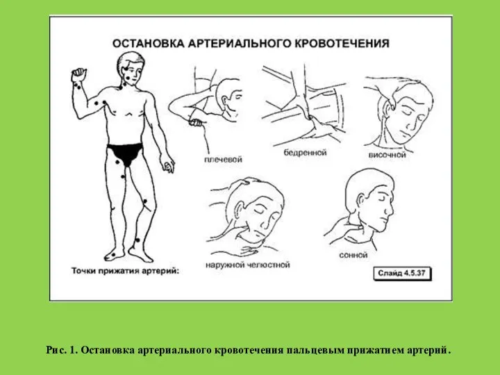 Рис. 1. Остановка артериального кровотечения пальцевым прижатием артерий.