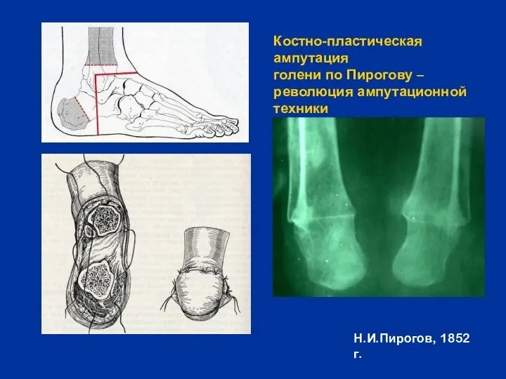 Костно-пластическая ампутация голени по Пирогову – революция ампутационной техники Н.И.Пирогов, 1852 г.