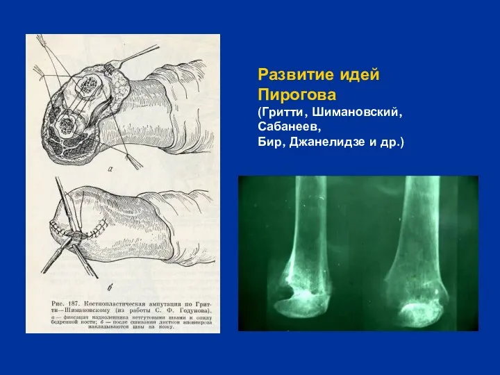 Развитие идей Пирогова (Гритти, Шимановский, Сабанеев, Бир, Джанелидзе и др.)