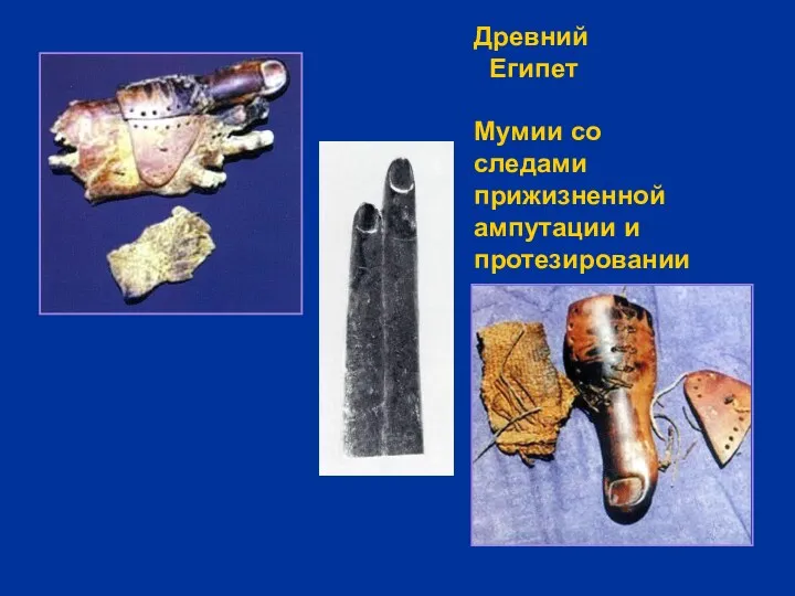 Древний Египет Мумии со следами прижизненной ампутации и протезировании