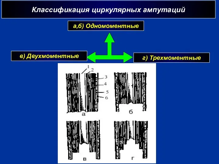 Классификация циркулярных ампутаций а,б) Одномоментные в) Двухмоментные г) Трехмоментные