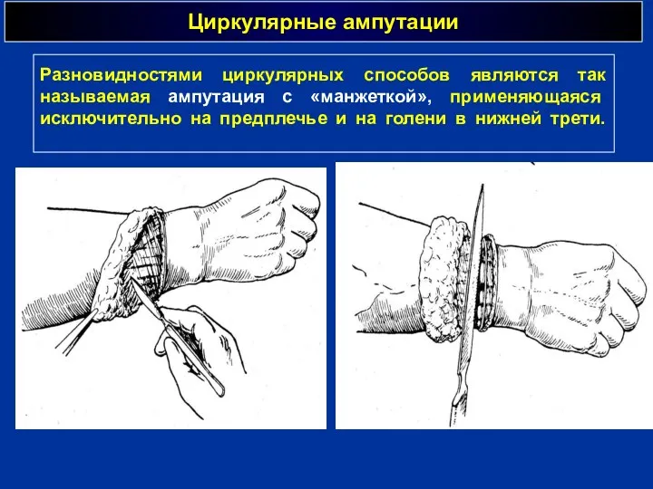 Циркулярные ампутации Разновидностями циркулярных способов являются так называемая ампутация с