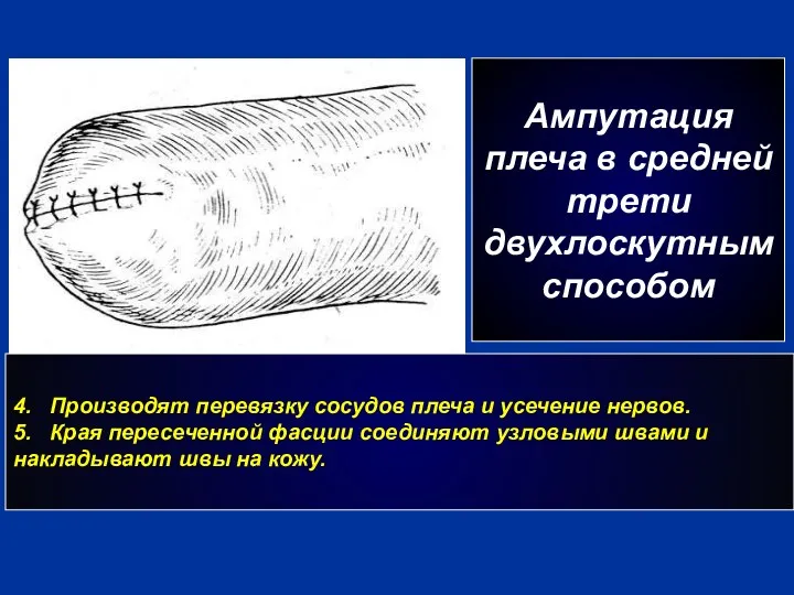 г Ампутация плеча в средней трети двухлоскутным способом 4. Производят перевязку сосудов плеча