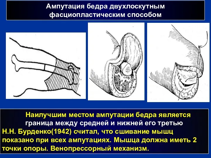 Ампутация бедра двухлоскутным фасциопластическим способом Наилучшим местом ампутации бедра является