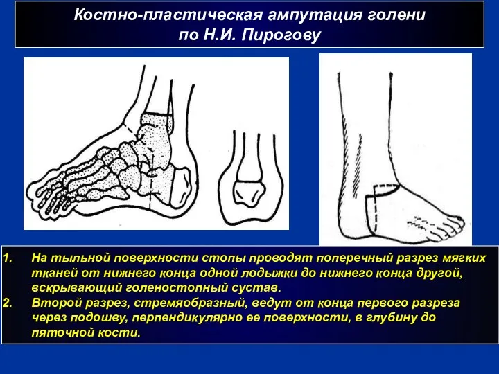 Костно-пластическая ампутация голени по Н.И. Пирогову г На тыльной поверхности стопы проводят поперечный