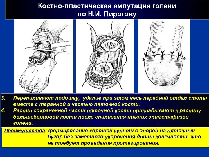 г Преимущества: формирование хорошей культи с опорой на пяточный бугор