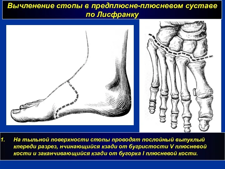 Вычленение стопы в предплюсне-плюсневом суставе по Лисфранку На тыльной поверхности стопы проводят послойный
