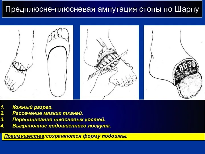 Предплюсне-плюсневая ампутация стопы по Шарпу г Преимущества:сохраняются форму подошвы. Кожный