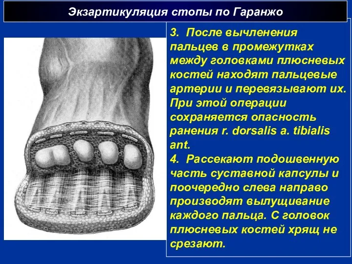 3. После вычленения пальцев в промежутках между головками плюсневых костей находят пальцевые артерии