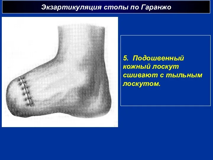 Экзартикуляция стопы по Гаранжо 5. Подошвенный кожный лоскут сшивают с тыльным лоскутом.