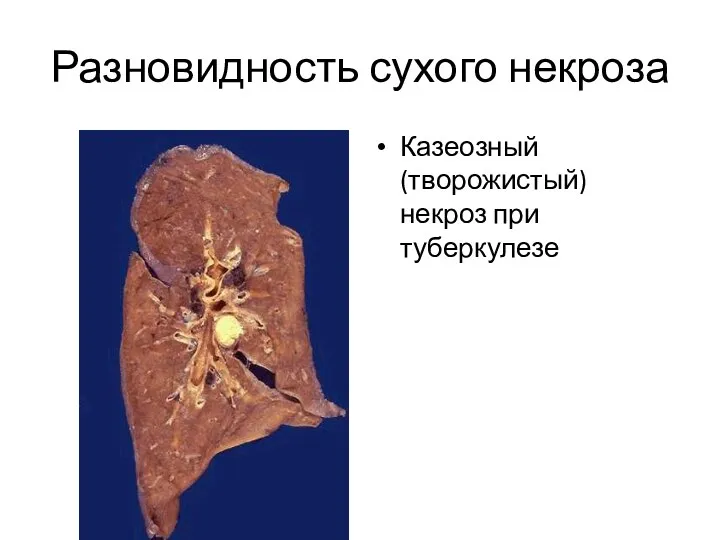 Разновидность сухого некроза Казеозный (творожистый) некроз при туберкулезе