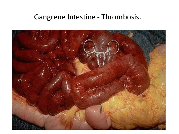 Gangrene Intestine - Thrombosis.