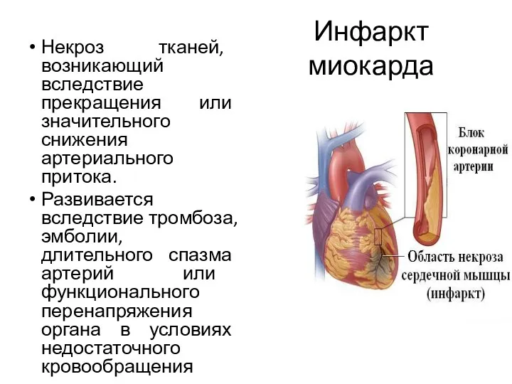 Инфаркт миокарда Некроз тканей, возникающий вследствие прекращения или значительного снижения артериального притока. Развивается
