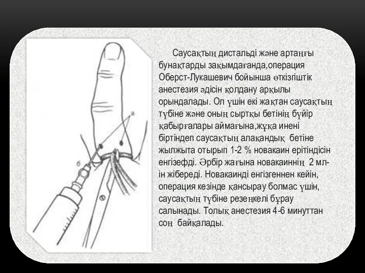 Саусақтың дистальді және артаңғы бунақтарды зақымдағанда,операция Оберст-Лукашевич бойынша өткізгіштік анестезия