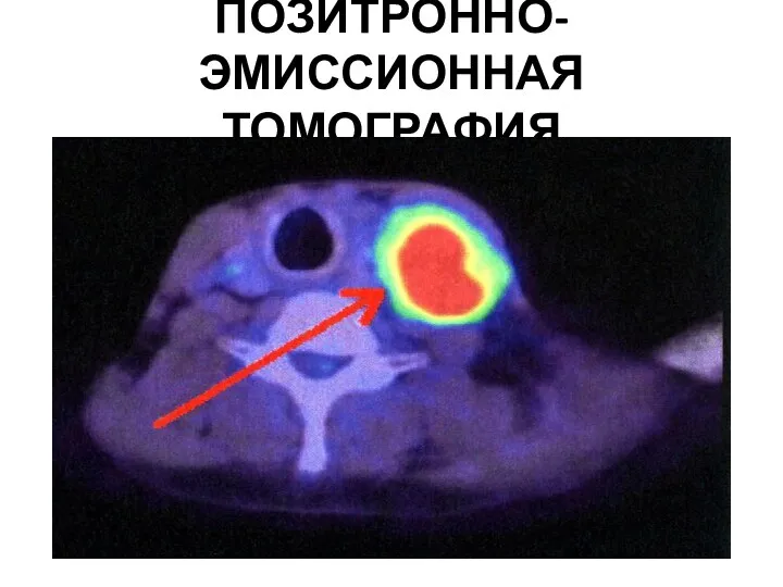 ПОЗИТРОННО-ЭМИССИОННАЯ ТОМОГРАФИЯ