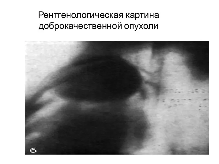 Рентгенологическая картина доброкачественной опухоли