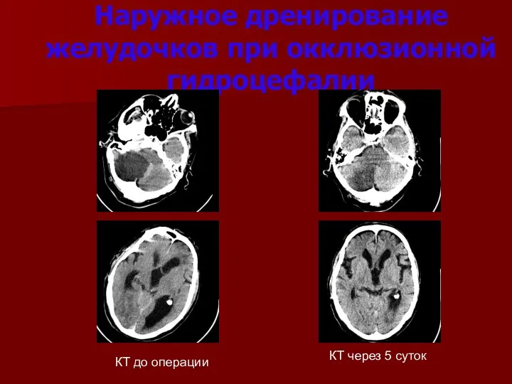 Наружное дренирование желудочков при окклюзионной гидроцефалии КТ до операции КТ через 5 суток