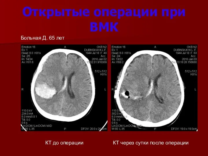 Открытые операции при ВМК КТ до операции КТ через сутки после операции Больная Д. 65 лет