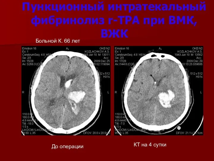 Пункционный интратекальный фибринолиз r-TPA при ВМК, ВЖК До операции КТ