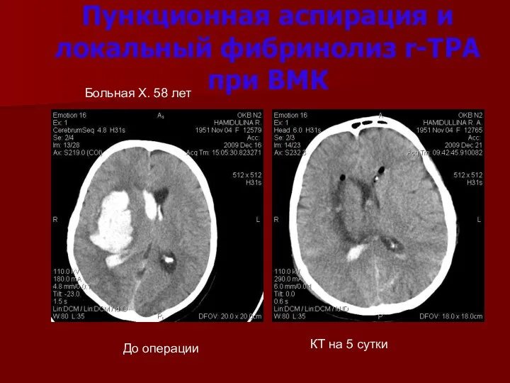 Пункционная аспирация и локальный фибринолиз r-TPA при ВМК Больная Х.