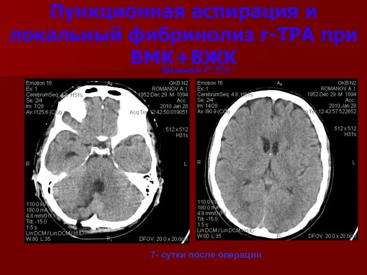 Пункционная аспирация и локальный фибринолиз r-TPA при ВМК+ВЖК 7- сутки после операции Больной Р. 57л.