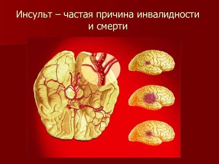 Инсульт – частая причина инвалидности и смерти