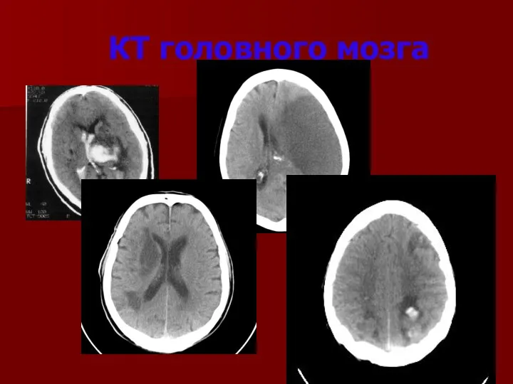 КТ головного мозга