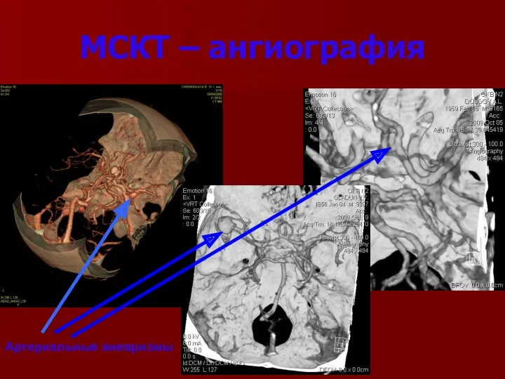 МСКТ – ангиография Артериальные аневризмы