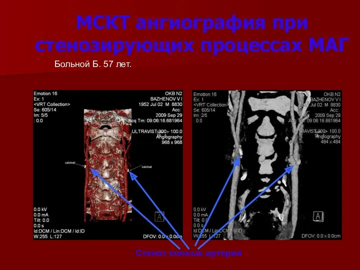 МСКТ ангиография при стенозирующих процессах МАГ Больной Б. 57 лет. Стеноз сонных артерий