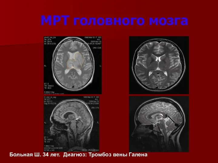 МРТ головного мозга Больная Ш. 34 лет. Диагноз: Тромбоз вены Галена