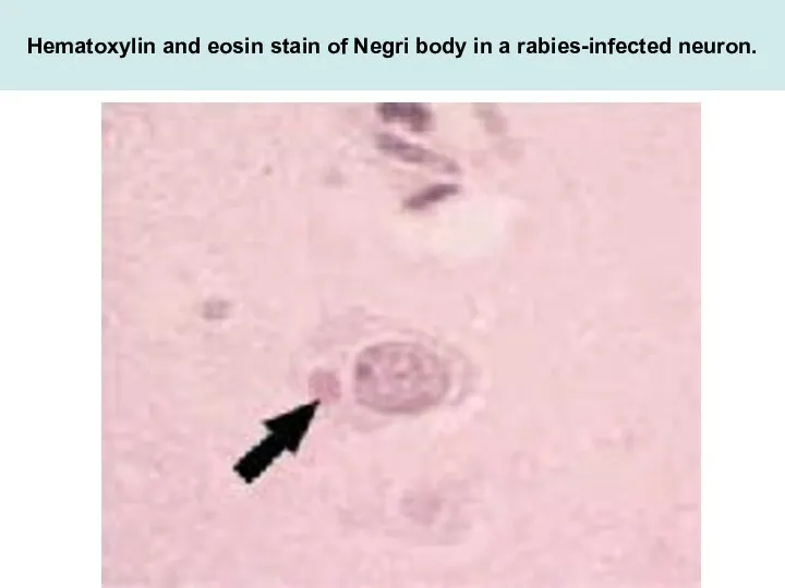 Hematoxylin and eosin stain of Negri body in a rabies-infected neuron.