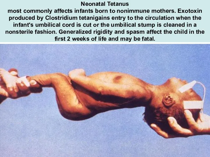 Neonatal Tetanus most commonly affects infants born to nonimmune mothers.