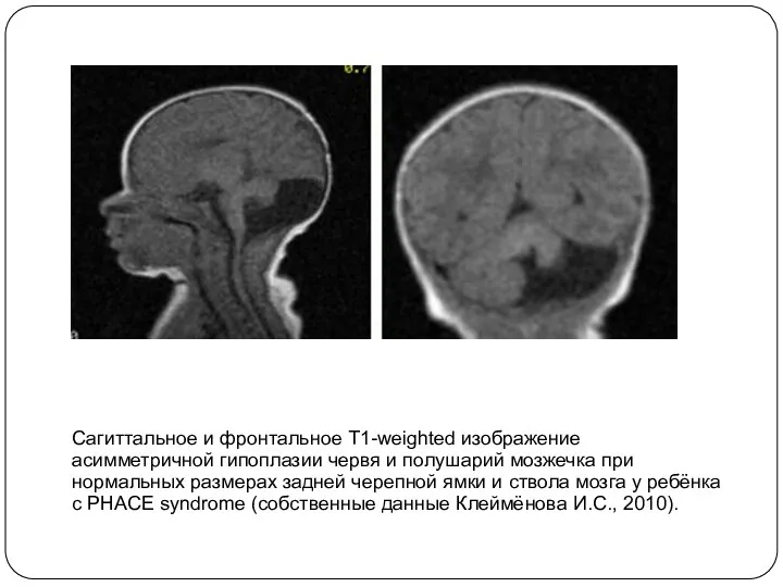 Сагиттальное и фронтальное T1-weighted изображение асимметричной гипоплазии червя и полушарий мозжечка при нормальных