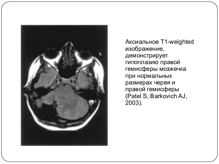 Аксиальное T1-weighted изображение, демонстрирует гипоплазию правой гемисферы мозжечка при нормальных