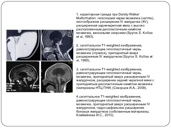1. характерная триада при Dandy-Walker Malformation: гипоплазия червя мозжечка (vermis), кистообразное расширение IV