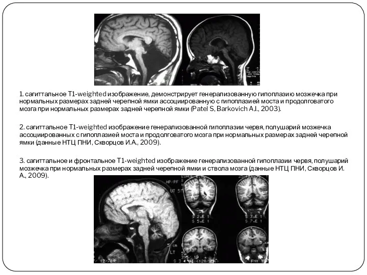1. сагиттальное T1-weighted изображение, демонстрирует генерализованную гипоплазию мозжечка при нормальных размерах задней черепной